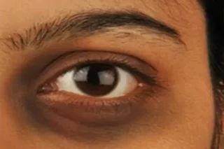 Dark-Circles Treatment clinic mumbai