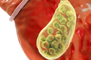 Ayurvedic Gallbladder Stone Treatment in Mumbai