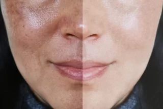 Melasma-Hyperpigmentation treatment clinic in Mumbai