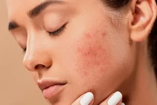 Ayurvedic Pimples Treatment Clinic