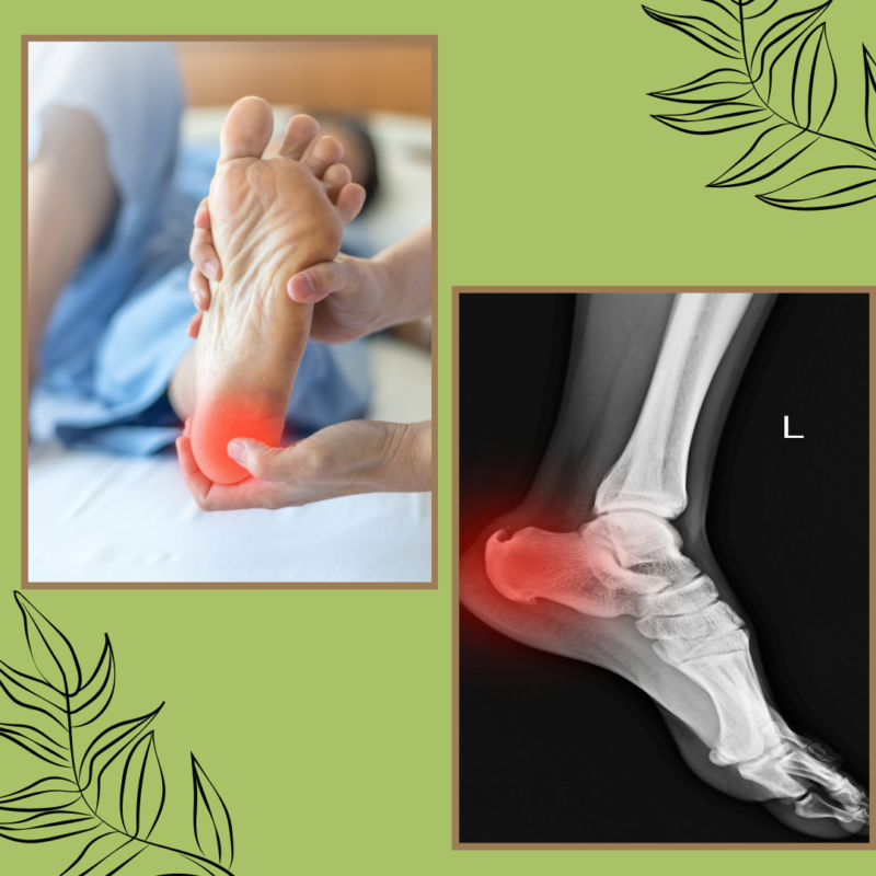 Ayurvedic Treatment For Heel Pain in Mumbai-Calcaneal Spur